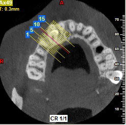 cbct img